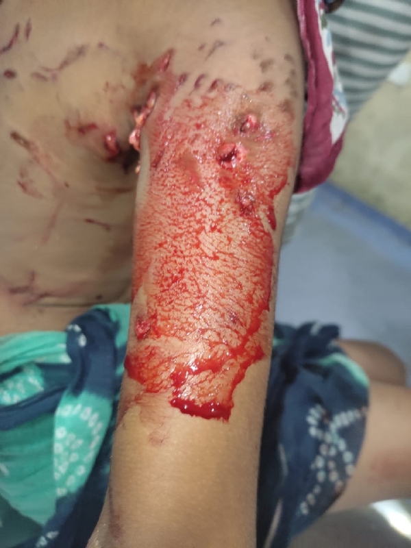 କୁକୁର କାମୁଡାରେ ଶିଶୁପୁତ୍ର ଗୁରୁତର : କଟକ ସ୍ଥାନାନ୍ତରିତ କୁକୁର କାମୁଡାରେ ଶିଶୁପୁତ୍ର ଗୁରୁତର : କଟକ ସ୍ଥାନାନ୍ତରିତ